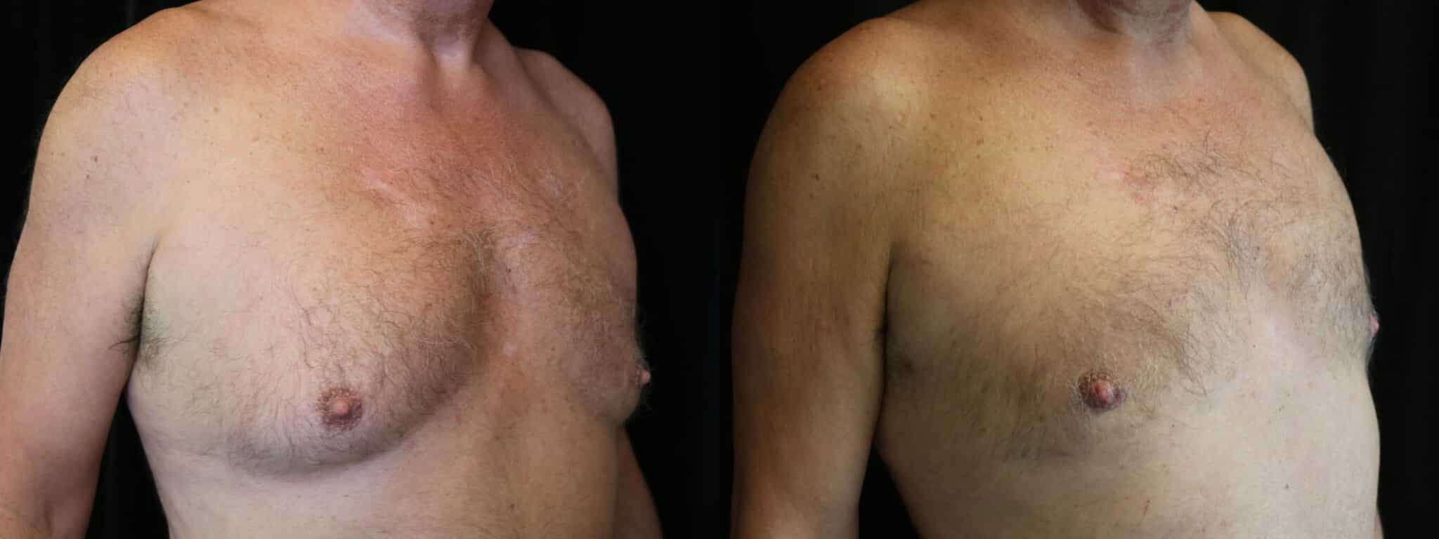 Gynecomastia Patient 9 Before & After Details