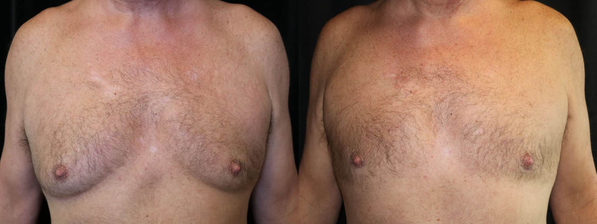 Gynecomastia Patient 9 Before & After