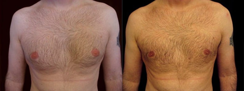 Gynecomastia Patient 10 Before & After