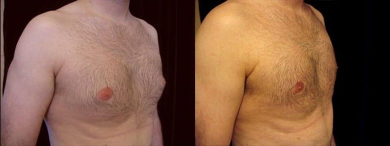 Gynecomastia Patient 10 Before & After Details