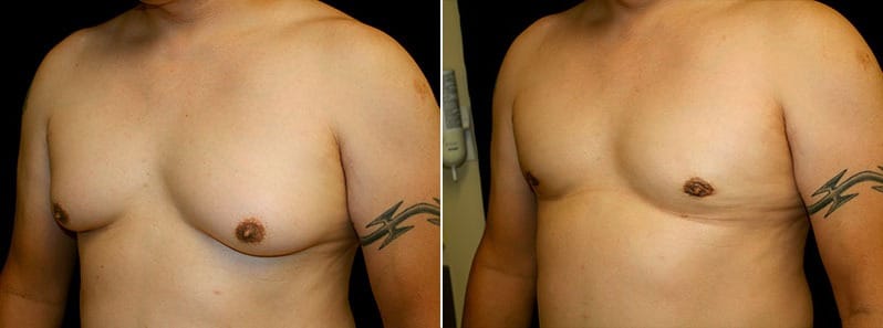 Gynecomastia Patient 16 Before & After Details