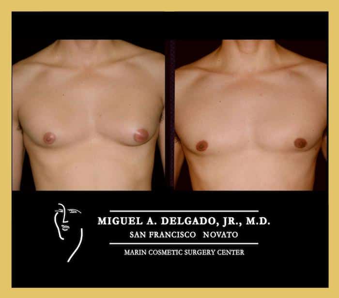 teenage gynecomastia puffy nipples, surgery before and after