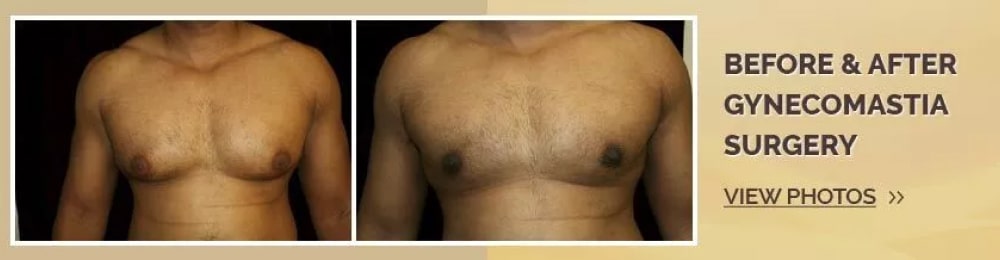 Gynecomastia Before and after results
