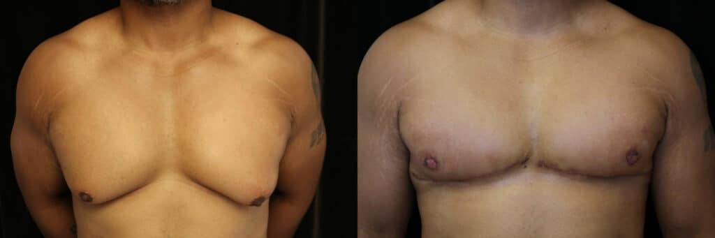 Patient with grade 3 gynecomastia after gynecomastia surgery with skin excision at 3 months.