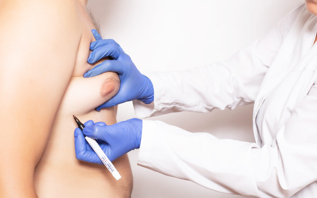 Anesthesia for Gynecomastia Surgery: Local, IV Sedation, and General Anesthesia