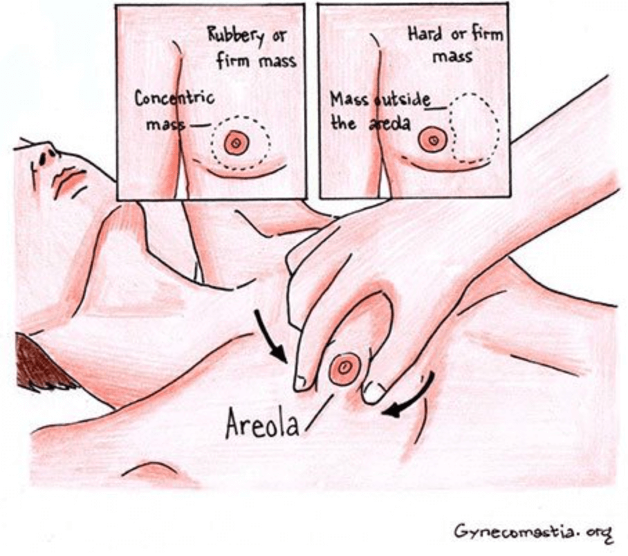 Diagram of a gynecomastia procedure