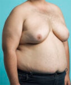 Upper body of patient in pant