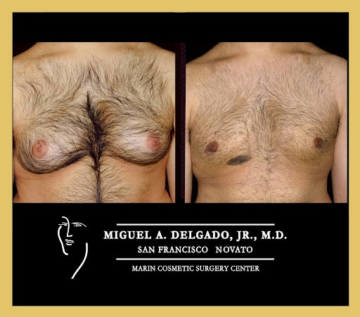 Patient of Dr Delgado with before and after gynecomastia surgery at 4 months.