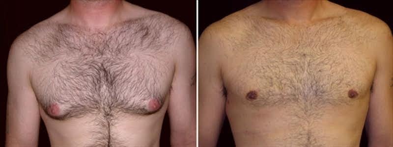 An image representing the initial recovery phase after gynecomastia surgery at 3 weeks.