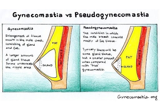 Diagram showing the difference between gynecomastia and pseudogynecomastia.