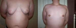Adolescent gynecomastia patient before and after surgery.