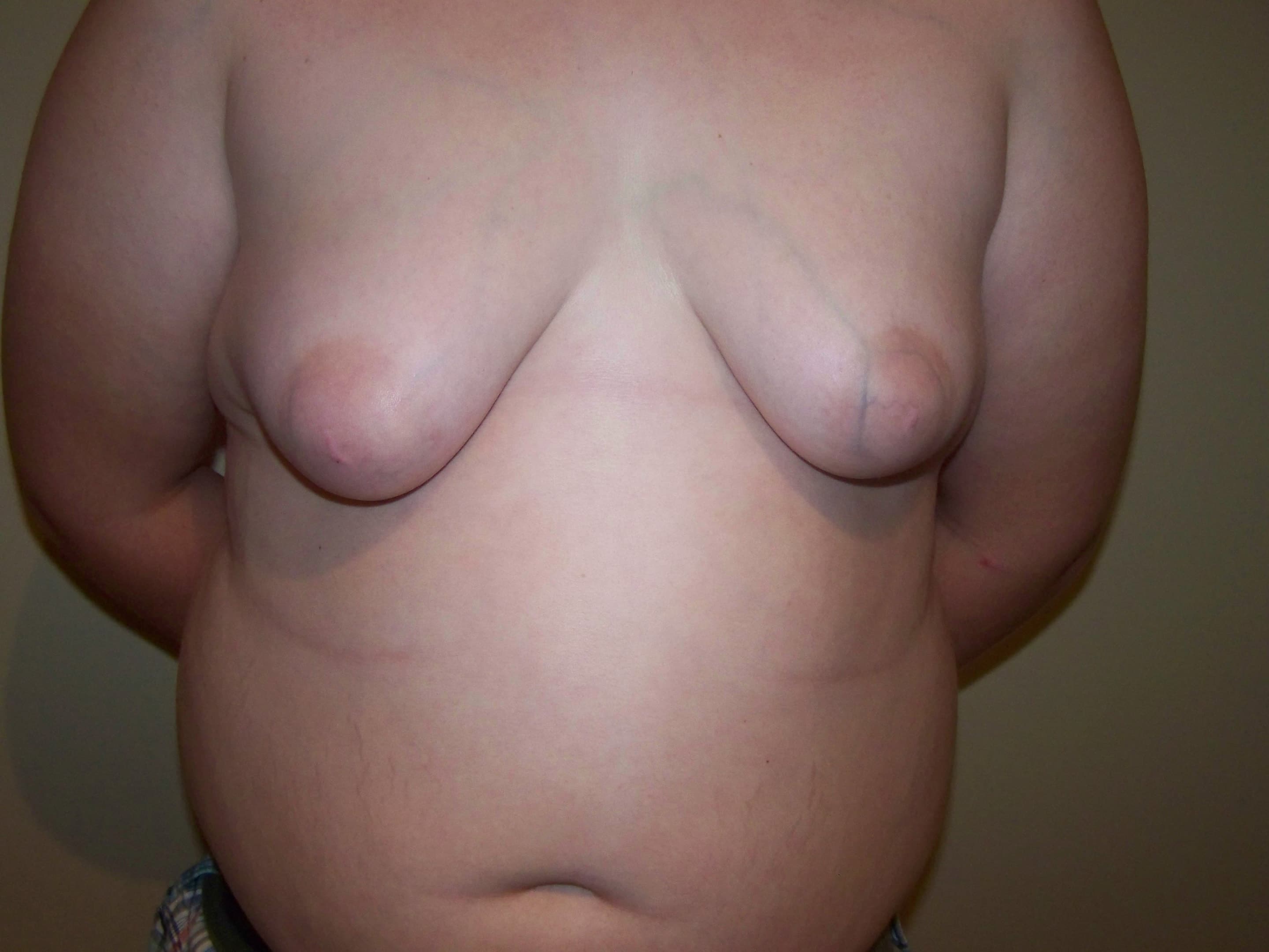 A patient of Dr. Delgado who is 14 yrs old with adolescent gynecomastia.