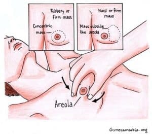 Diagram of gynecomastia