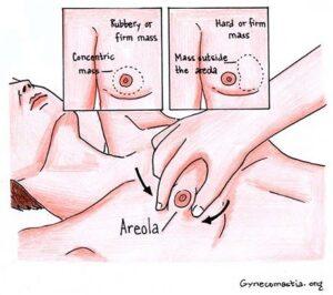 Gynecomastia diagram